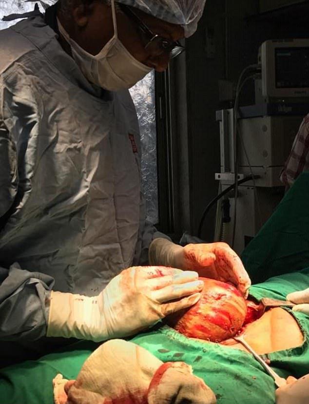 Хирурги извлекли из мочевого пузыря пациента огромный камень