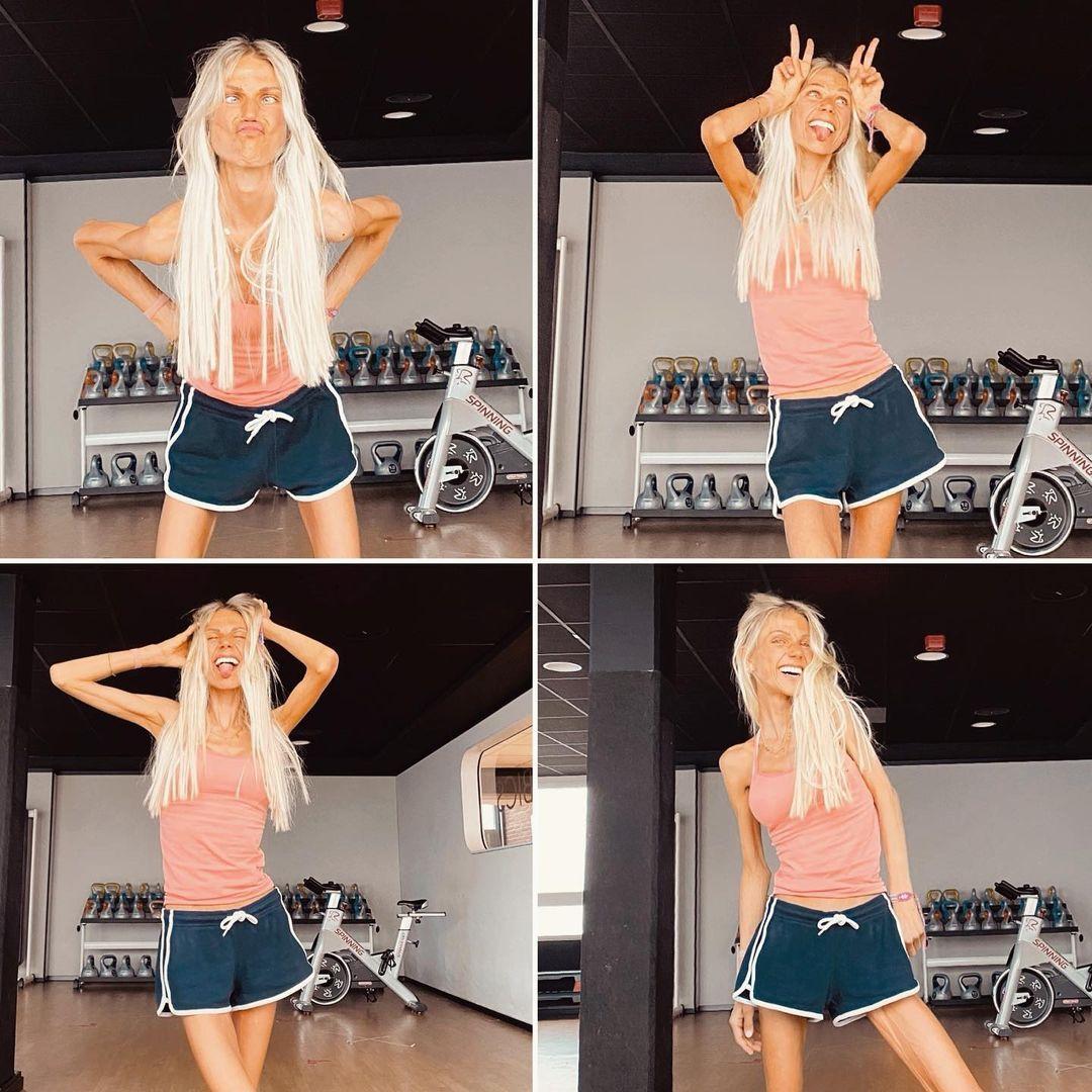 24-летняя блогерша из Instagram умерла от анорексии во сне