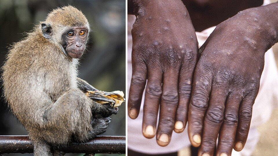 Власти США объявили чрезвычайную ситуацию в связи с быстрым распространением оспы обезьян.