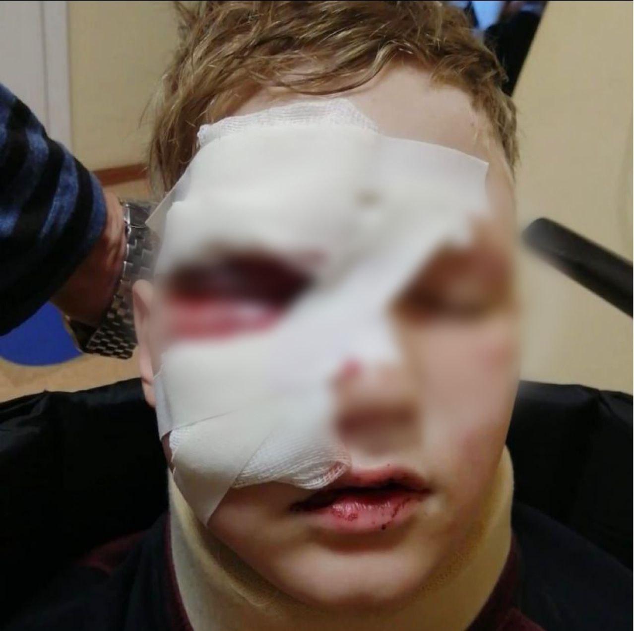 Взорвавшаяся пивная кега разворотила лицо школьнику в Томске.