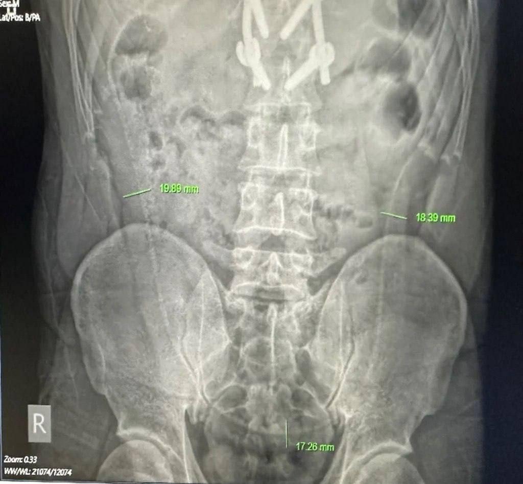 Мужик во Вьетнаме засунул себе в анус живого 65-сантиметрового угря и чуть не умер