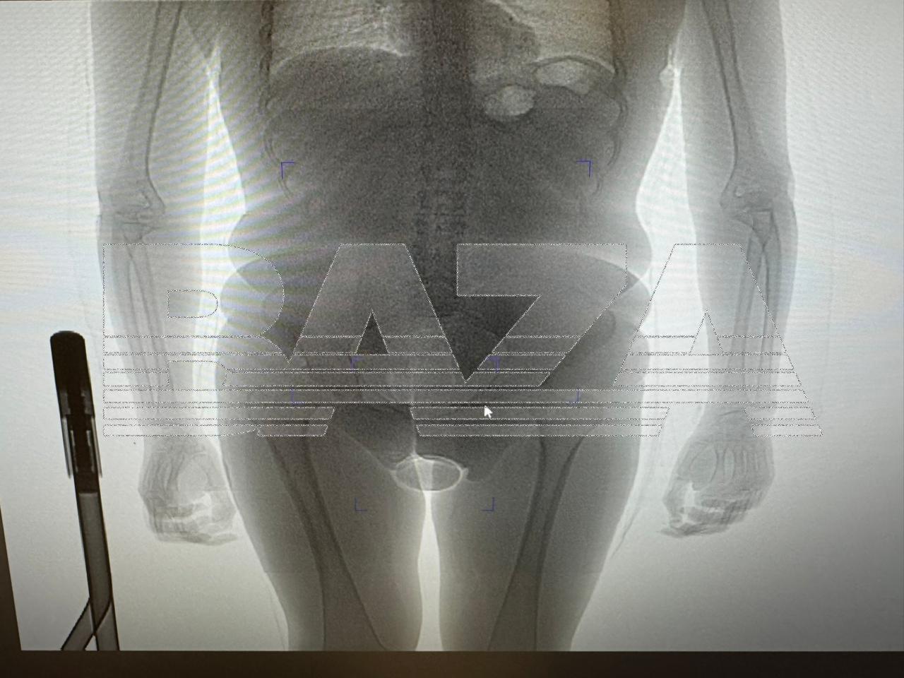 Трансвестит из Бразилии попытался провезти в себе 250 граммов кокаина