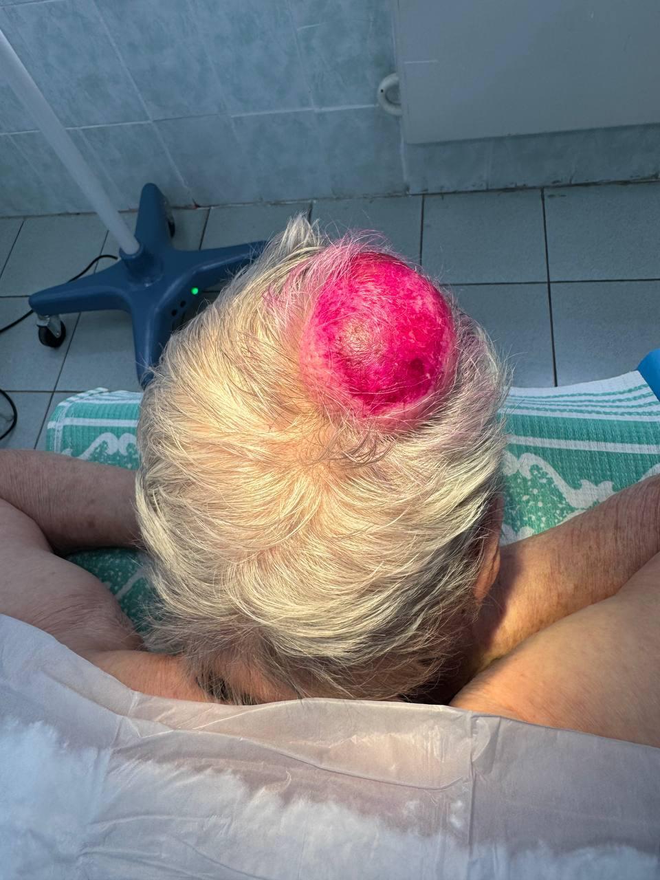 Шишку размером с бильярдный шар удалили врачи в Наро-Фоминске у 90-летней пациентки.