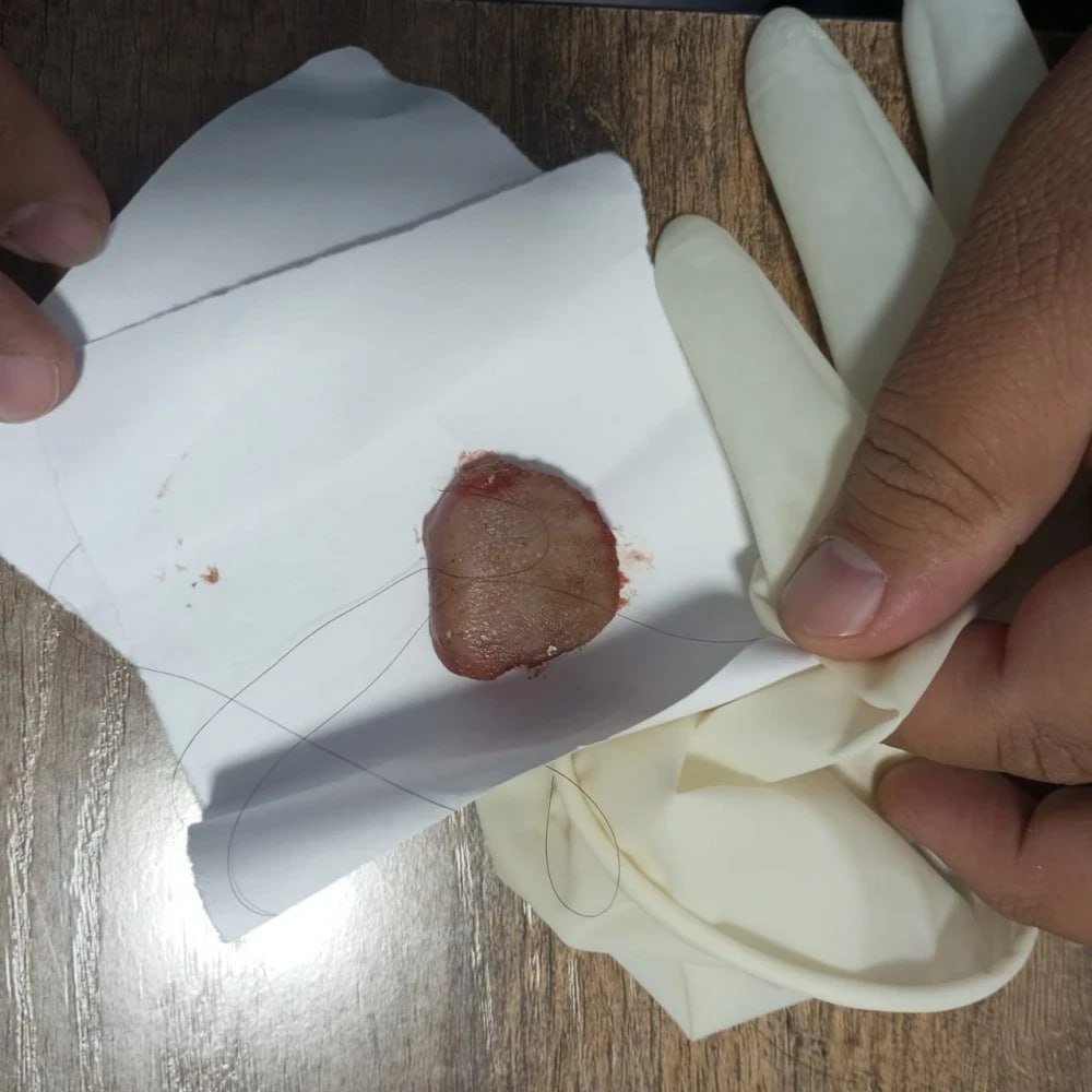 Девушка откусила язык парню во время поцелуя