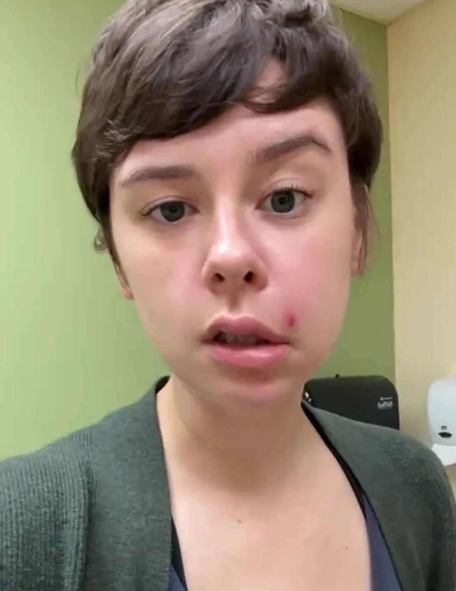 У девушки перекосило лицо от выдавленного прыща