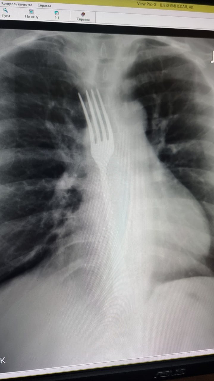 Белоруска случайно проглотила вилку, пытаясь вызвать рвоту